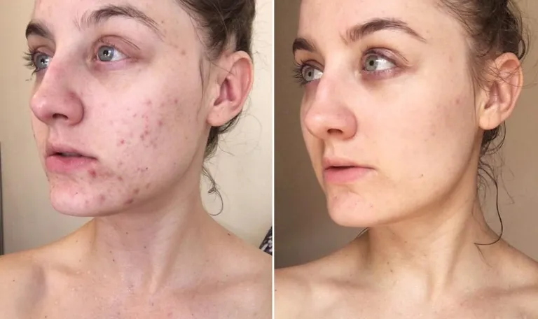 Review 6 miếng dán trị mụn tốt nhất: 'vũ khí' che và trị mụn cấp tốc